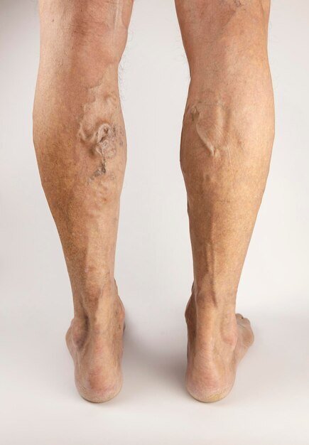 Satisfaction with successful varicose vein treatment using sclerotherapy