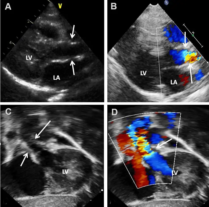اکوکاردیوگرافی بافتی