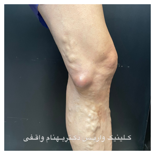 الدوالي الجذعية