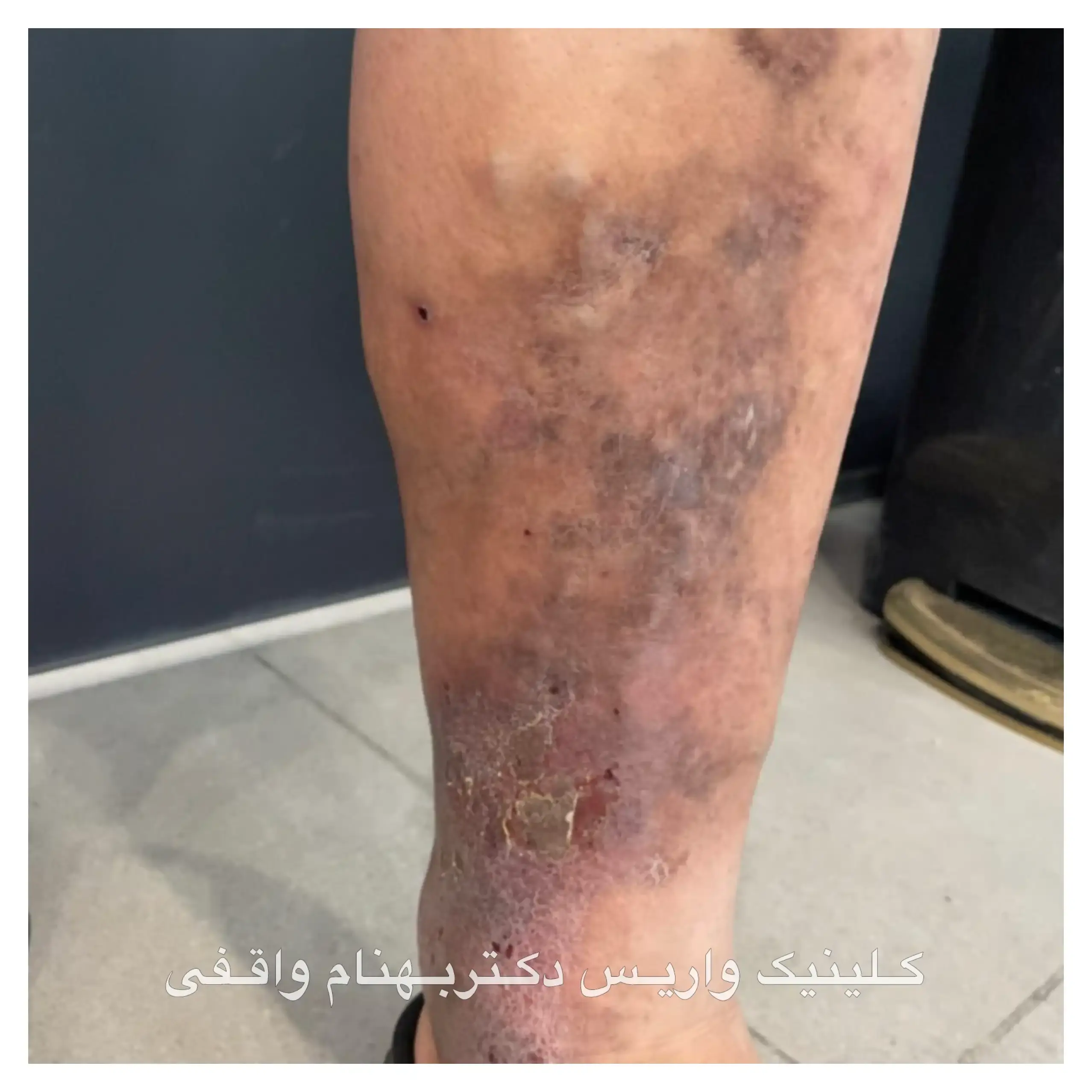 ألم دوالي الساق