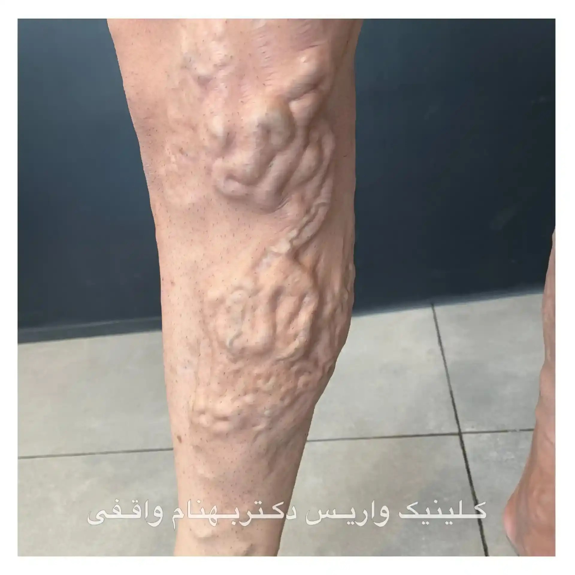 اقدامات لازم جهت درمان واریس پا