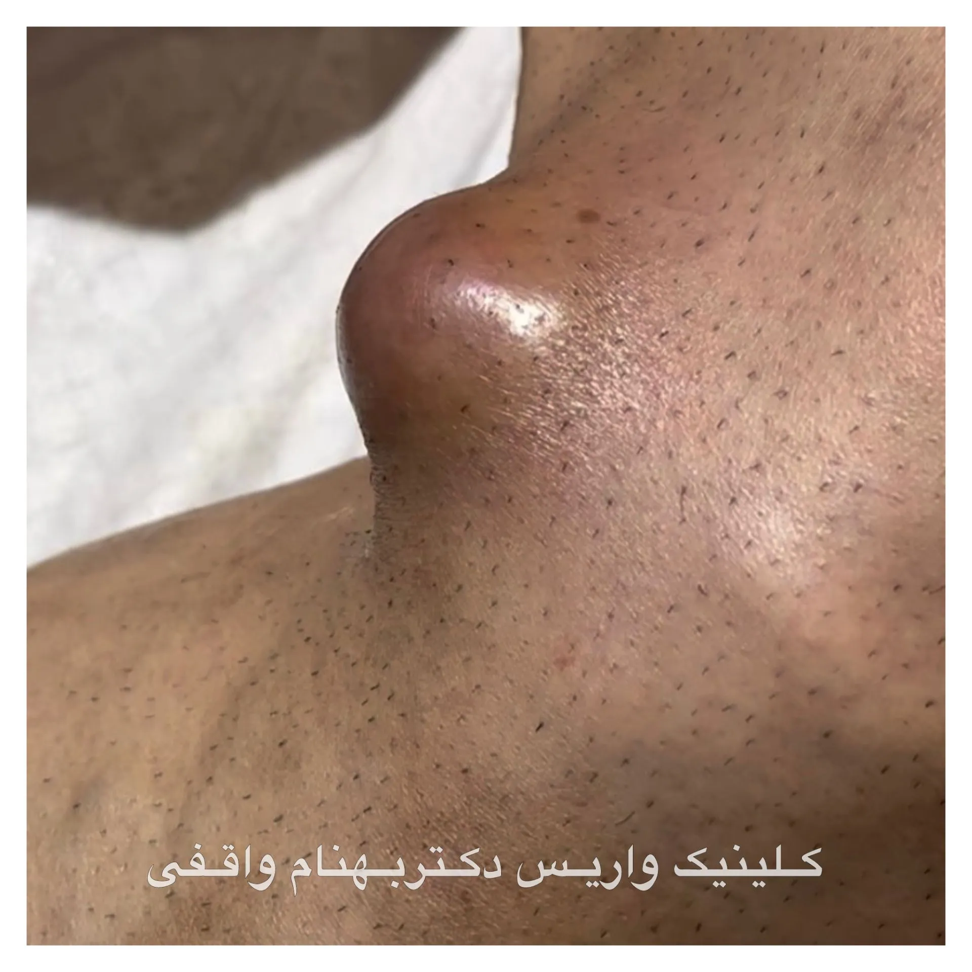 عکس عوارض شدید واریس پا