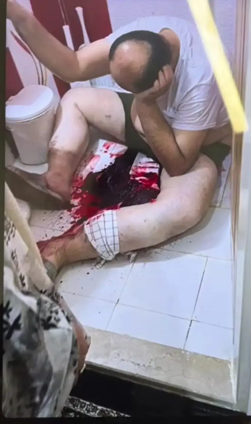 ضعف جدران الأوردة في الدوالي