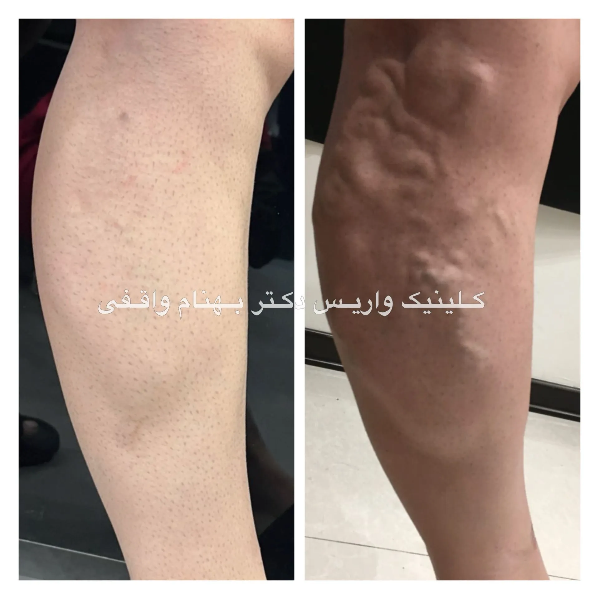 درمان واریس طنابی با لیزر ابلیشن &nbsp;evlt
