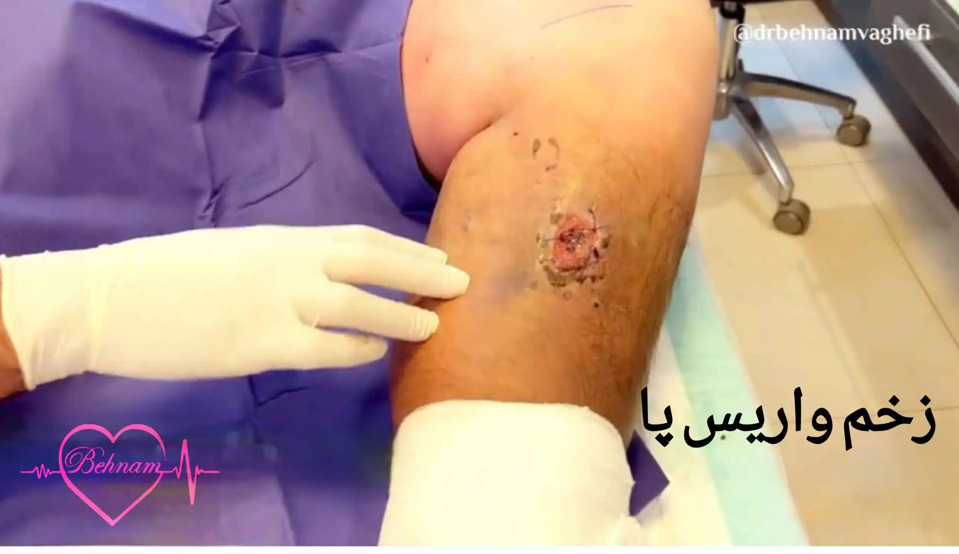 Varicose ulcers
