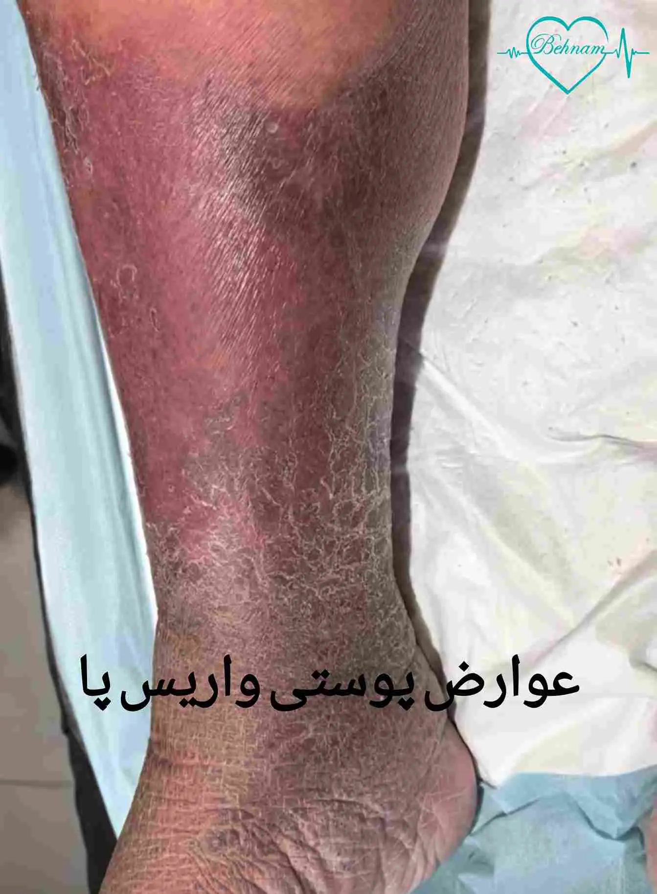 المضاعفات الجلدية والأنسجة الناتجة عن دوالي الساقين