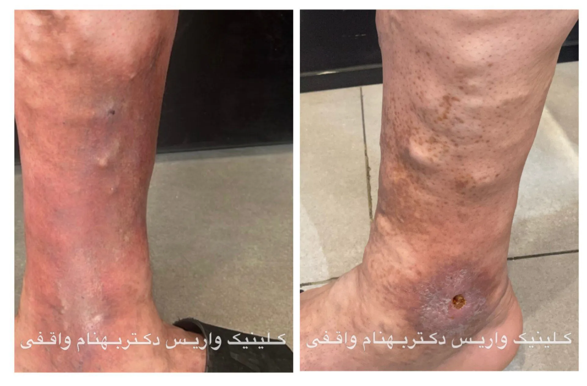 عکس عوارض واریس پا