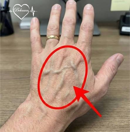 Veins on Hands and Fingers