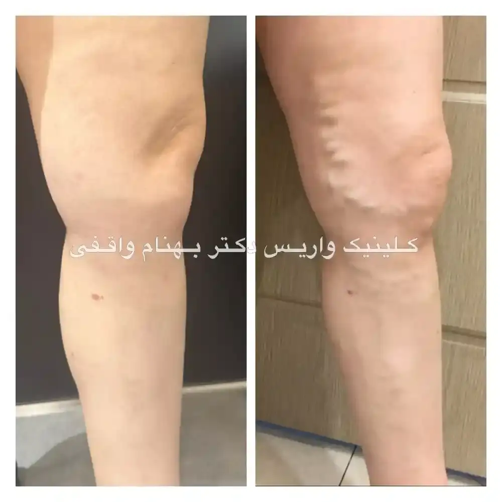قبل و بعد از لیزر واریس