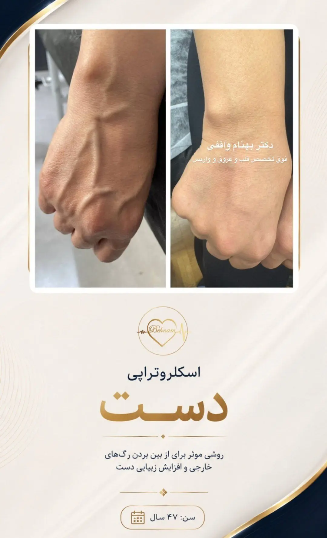 عکس قبل و بعد درمان واریس دست توسط دکتر واقفی