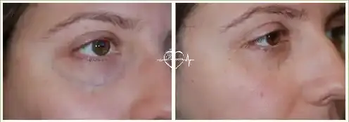 دوالي وأوعية تحت العينين