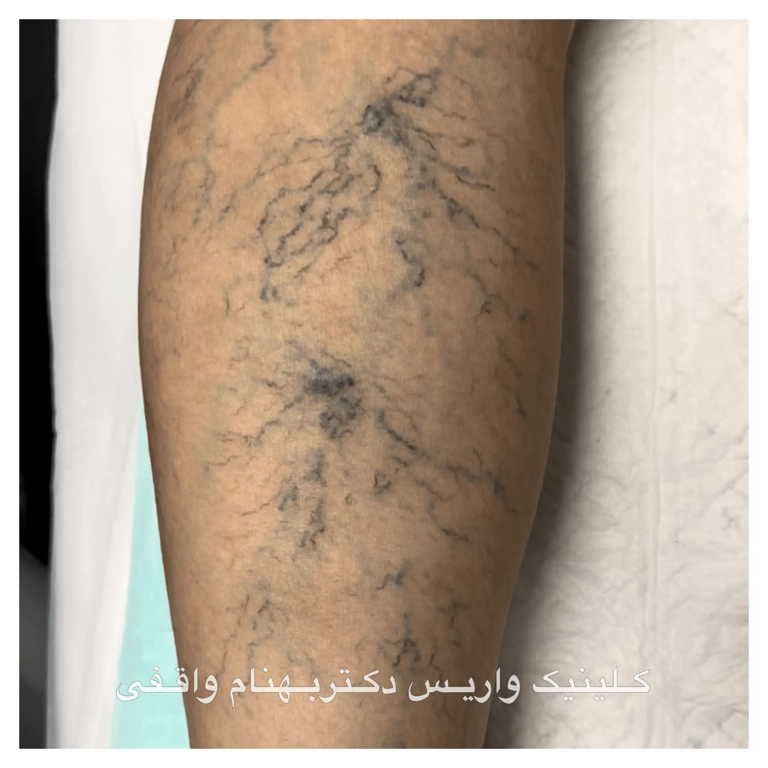 واریس عنکبوتی پا