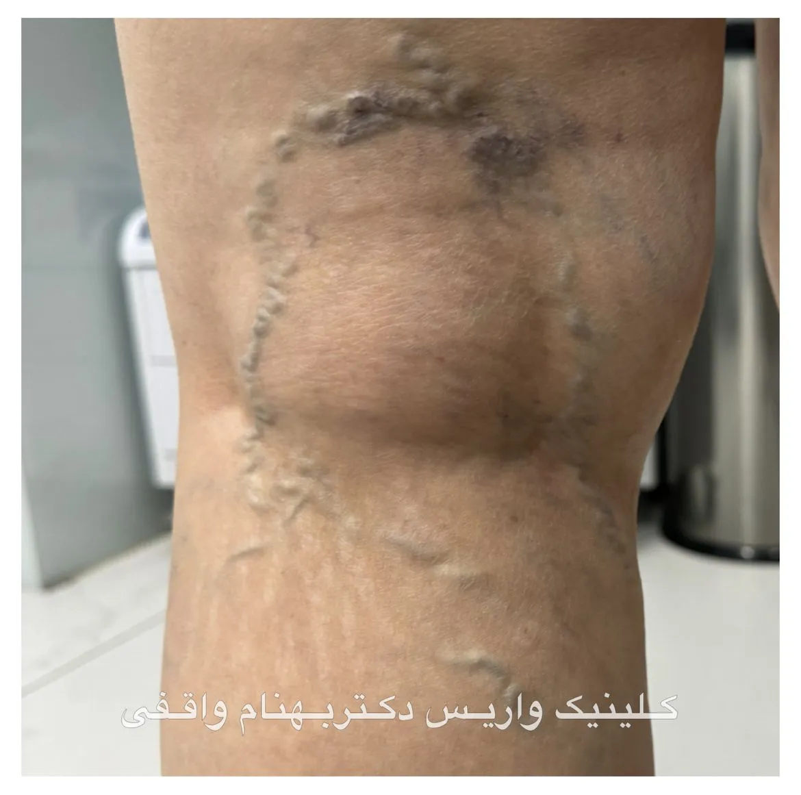واریس مشبک یا رتیکولر