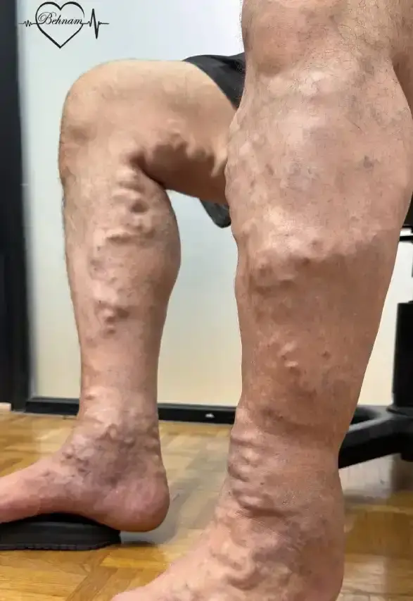 عکس واریس پا