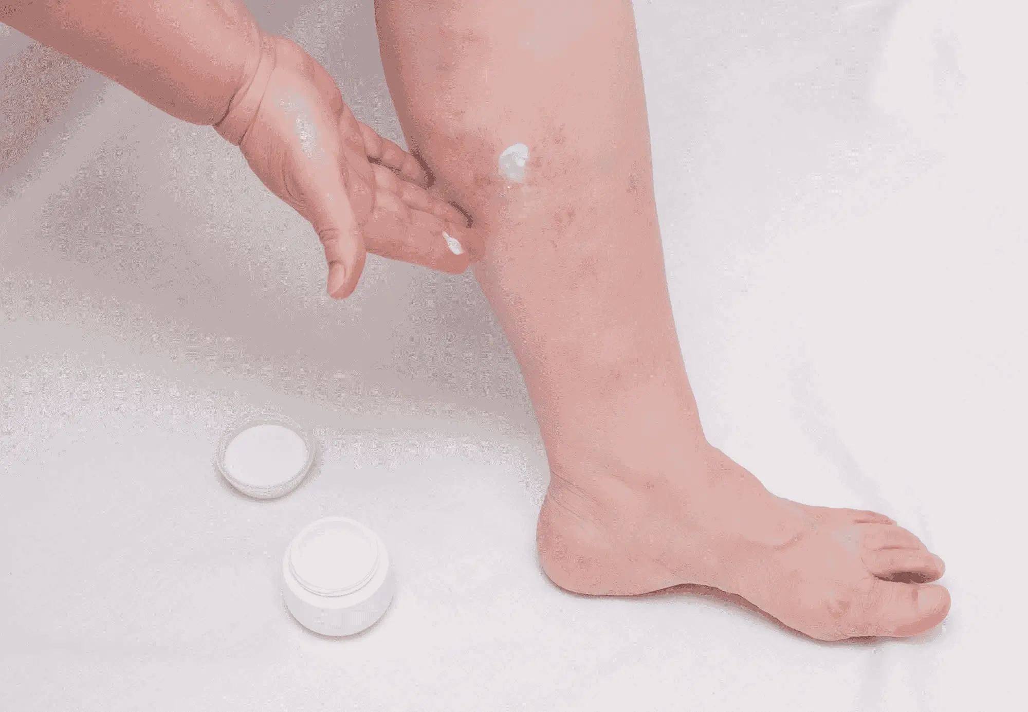 Varicose Vein Ointment